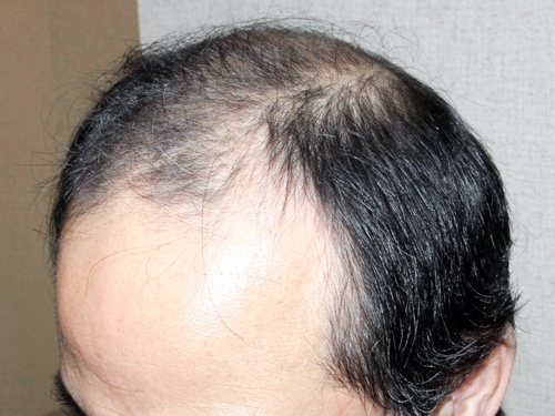 57歳 4 565株 メガセッション 自毛植毛2万件の紀尾井町クリニック 東京 大阪
