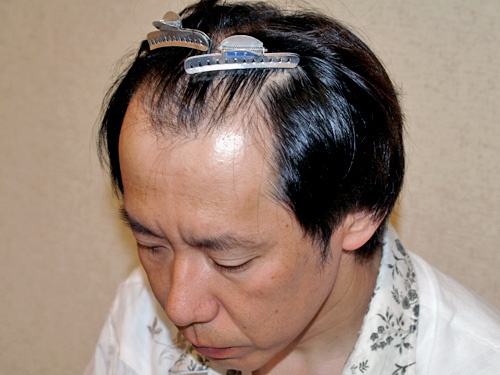 41歳 1,400株 前頭部から頭頂部（広範囲）の植毛 自毛植毛は紀尾井町クリニック [東京・大阪]