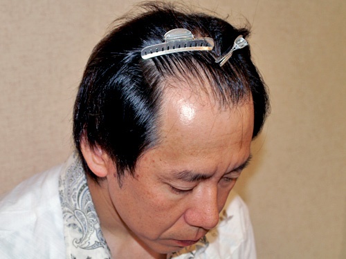 41歳 1,400株 前頭部から頭頂部（広範囲）の植毛 自毛植毛は紀尾井町クリニック [東京・大阪]