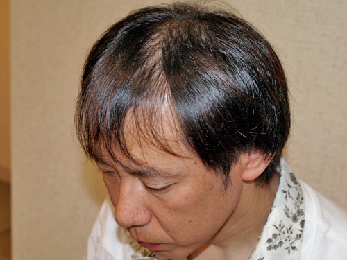 41歳 1,400株 前頭部から頭頂部（広範囲）の植毛 自毛植毛は紀尾井町クリニック [東京・大阪]