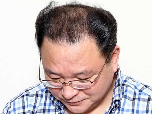 49歳 2,320株 メガセッション 自毛植毛は紀尾井町クリニック [東京・大阪]