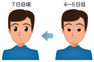 まぶたの腫れ