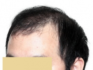 術後6ヶ月の写真