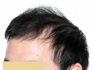 術後9ヶ月の写真