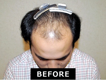 自毛植毛2万件の紀尾井町クリニック 東京 大阪