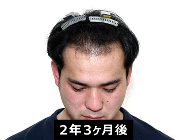 自毛植毛2万件の紀尾井町クリニック 東京 大阪