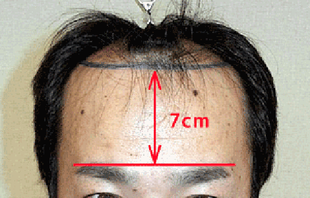 眉毛から生え際までは若い方で標準約7cm