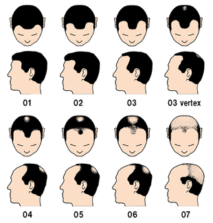 男性型脱毛症（AGA）の進行パターン
