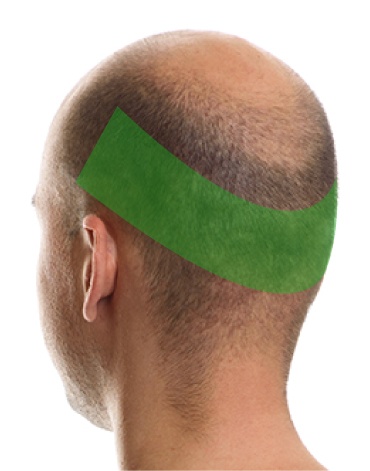 AGAの影響を受けない後頭部（緑色の部分）からドナー株を採取し移植