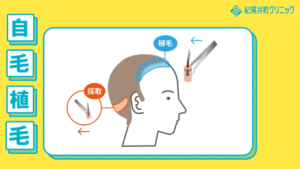 【動画】自毛植毛とは