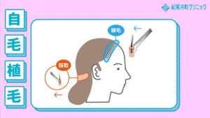 【動画】自毛植毛とは（FAGA）