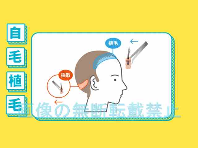 植毛とは?