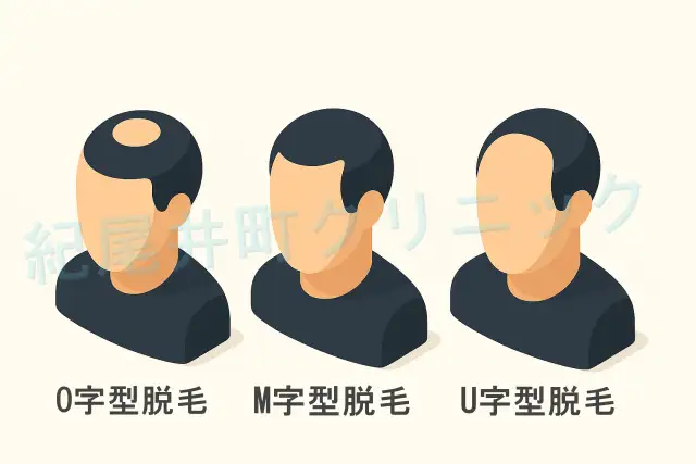 薄毛(はげ・脱毛症)について 原因と予防、対策・治療法を紹介
