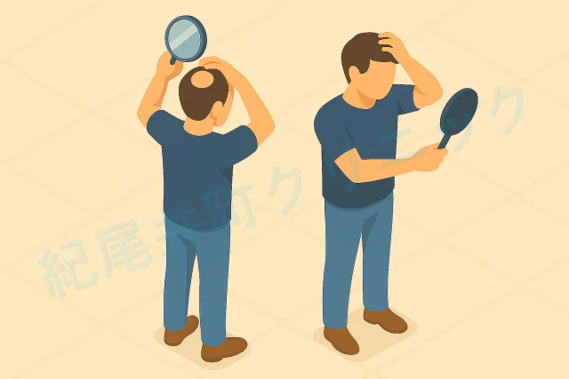 AGAの脱毛の兆候(はげる前兆)について