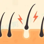 自毛植毛した毛包が定着しない理由は？【医師監修】