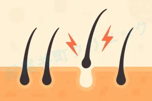 自毛植毛した毛包が定着しない理由は？【医師監修】