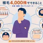 植毛4,000株でできることは？範囲・費用・向いているケースを解説【医師監修】